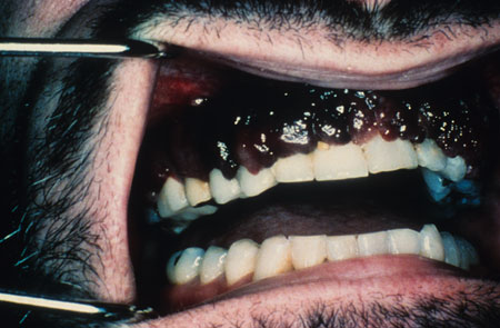 image of Kaposi sarcoma: gingival lesions