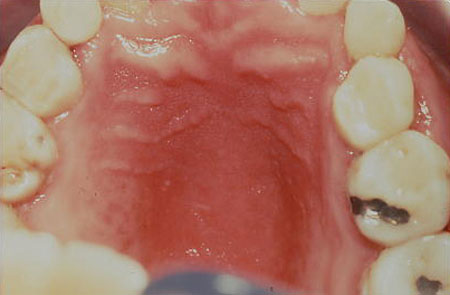 image of Candidiasis: erythematous (atrophic)