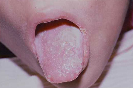 image of Candidiasis and herpes simplex: oral