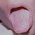 thumbnail image of Candidiasis and herpes simplex: oral