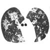 thumbnail image of  Pneumocystis jiroveci
                    : HRCT scan in a patient with a normal chest X ray
                