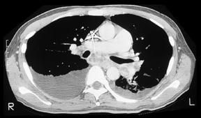 image of Tuberculosis: chest CT with findings of mycobacterial vs fungal disease