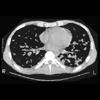 thumbnail image of Kaposi sarcoma: chest CT with typical findings