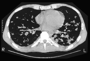image of Kaposi sarcoma: chest CT with typical findings