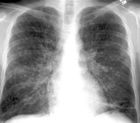 image of Coccidioidomycosis: chest X ray with a miliary pattern suggesting fungal or mycobacterial disease