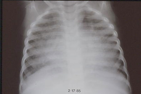 image of Lymphocytic interstitial pneumonitis/pulmonary lymphocytic hyperplasia: chest radiograph