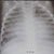 thumbnail image of Lymphocytic interstitial pneumonitis/pulmonary lymphocytic hyperplasia: chest radiograph
