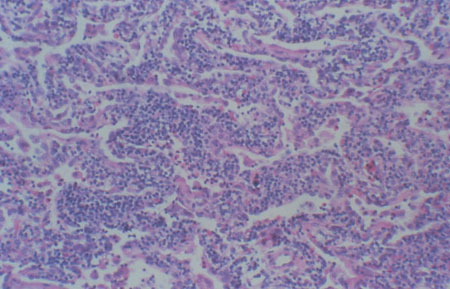 image of Lymphocytic interstitial pneumonitis/pulmonary lymphocytic hyperplasia: lung biopsy