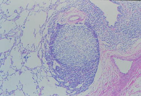 image of Lymphocytic interstitial pneumonitis/pulmonary lymphocytic hyperplasia: lung biopsy