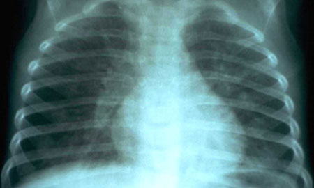 image of  Pneumocystis jiroveci
                    (formerly
                    carinii
                    ) pneumonia
                