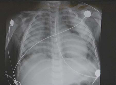 image of  Pneumocystis jiroveci
                    (formerly
                    carinii
                    ) pneumonia
                