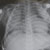 thumbnail image of  Pneumocystis jiroveci
                    (formerly
                    carinii
                    ) pneumonia
                