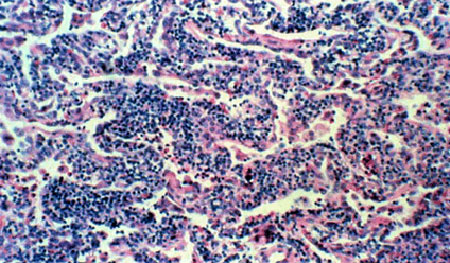 image of Lymphocytic interstitial pneumonitis