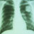 thumbnail image of Non-Hodgkin lymphoma: chest X ray showing isolated pulmonary nodule in patient with AIDS