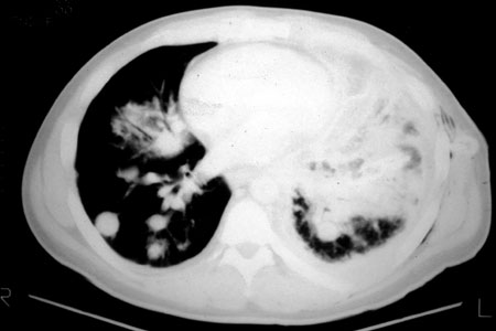 image of Non-Hodgkin lymphoma: CT scan of chest