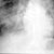 thumbnail image of Kaposi sarcoma: chest X ray showing pulmonary involvement