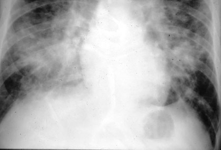 image of Kaposi sarcoma: chest X ray showing pulmonary involvement