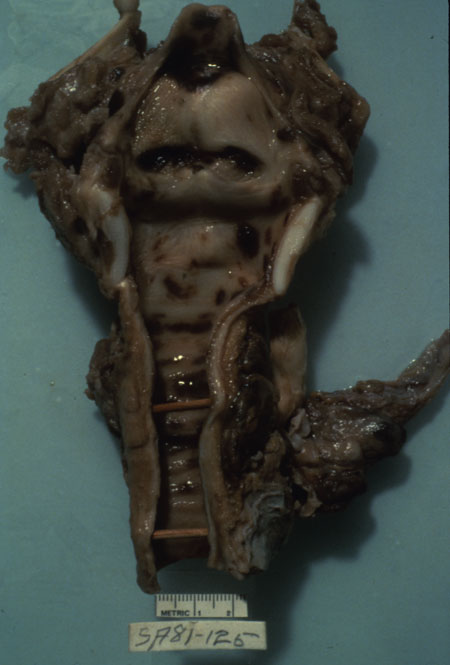 image of Kaposi sarcoma: trachea at autopsy