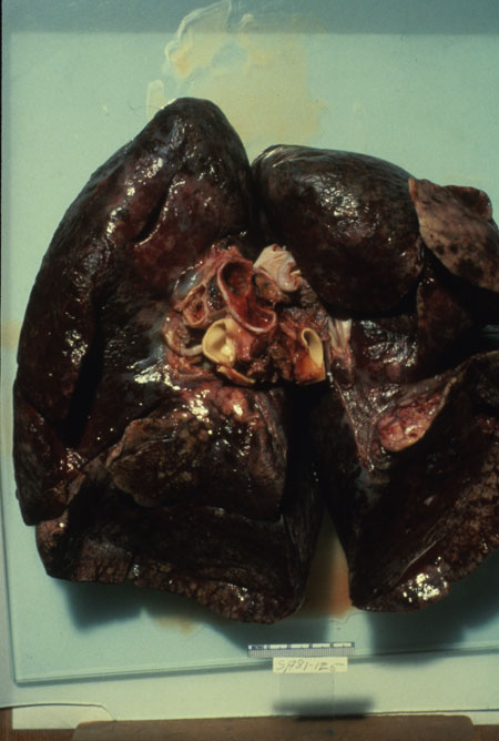 image of Kaposi sarcoma: lungs at autopsy