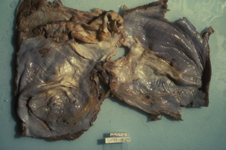 image of Kaposi sarcoma: diaphragm at autopsy