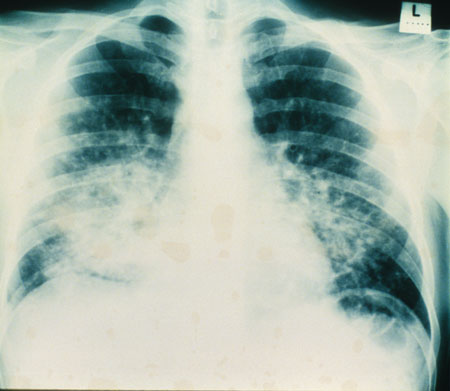 image of Kaposi sarcoma: chest X ray showing pulmonary involvement