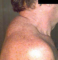 image of Lipoaccumulation: dorsocervical fat pad