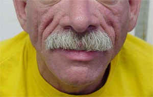 image of Lipoatrophy: facial fat loss