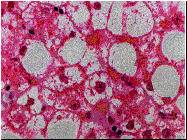 image of Hepatic steatosis: associated with lactic acidosis/acidemia