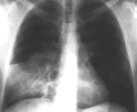 image of Pneumococcal pneumonia: bacteremic with cavitation and a new pleural effusion
