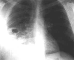 image of Repeat chest radiograph 5 days later when the patient developed right-sided pleuritic chest pain.