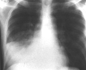 image of 
                    Pneumococcal pneumonia: bacteremic, with
                    Pneumocystis jiroveci
                    (formerly
                    carinii
                    )
                