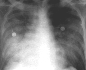 image of Pneumococcal pneumonia: bacteremic with worsening bilateral heterogenous infiltrates