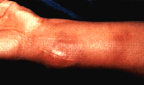 image of Bacillary angiomatosis: wrist mass