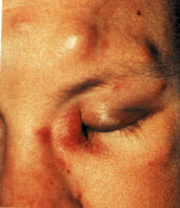 image of Bacillary angiomatosis: multiple subcutaneous nodules in a patient with Kaposi sarcoma