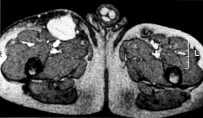 image of  Bartonella henselae
                    /Bacillary angiomatosis: soft-tissue mass in the right thigh
                