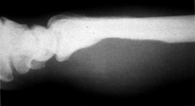 image of  Bartonella henselae
                    /Bacillary angiomatosis: wrist X ray
                