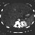 thumbnail image of  Bartonella henselae
                    /Bacillary angiomatosis: hepatosplenomegaly in peliosis hepatis
                