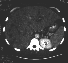 image of  Bartonella henselae
                    /Bacillary angiomatosis: hepatosplenomegaly in peliosis hepatis
                