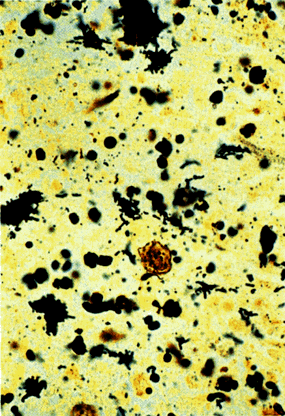 image of  Bartonella henselae
                    /Bacillary angiomatosis: cutaneous biopsy
                