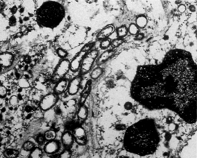 image of  Bartonella henselae
                    /Bacillary angiomatosis: cutaneous biopsy
                