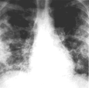 image of  Pneumocystis jiroveci
                    (formerly
                    carinii
                    ) pneumonia: with nodular infiltrates
                