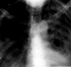 image of  Pneumocystis jiroveci
                    (formerly
                    carinii
                    ) pneumonia: predominant left-sided disease
                