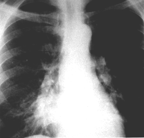 image of  Pneumocystis jiroveci
                    (formerly
                    carinii
                    ) pneumonia: unilateral alveolar infiltrate
                