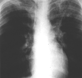 image of  Pneumocystis jiroveci
                    (formerly
                    carinii
                    ) pneumonia: chest X ray with apical infiltrate
                