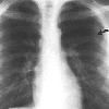 thumbnail image of Non-Hodgkin lymphoma: initial chest radiograph