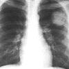 thumbnail image of Non-Hodgkin lymphoma: initial chest radiograph and radiograph 6 weeks later
