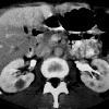 thumbnail image of Non-Hodgkin lymphoma: bilateral renal masses