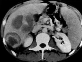 image of Non-Hodgkin lymphoma: multiple hepatic masses