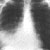 thumbnail image of 
                    Pneumococcal pneumonia: bacteremic, with
                    Pneumocystis jiroveci
                    (formerly
                    carinii
                    )
                