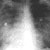 thumbnail image of Pneumococcal pneumonia: bacteremic with worsening bilateral heterogenous infiltrates